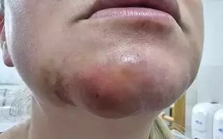 Cliente processa clínica após contrair bactéria em procedimento com ácido