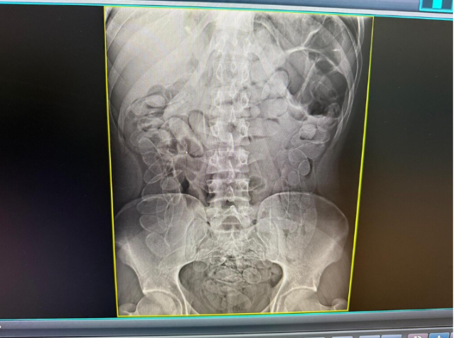 Boliviana é presa sete dias com 90 cápsulas de cocaína no estômago