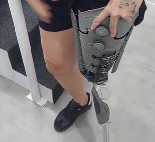 Vítima de acidente, jovem busca autonomia lutando por prótese de R$ 100 mil