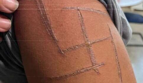 “Achei que iam me matar”, diz mulher trans espancada e marcada com suástica