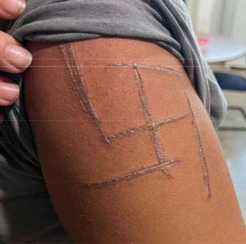 “Achei que iam me matar”, diz mulher trans espancada e marcada com suástica