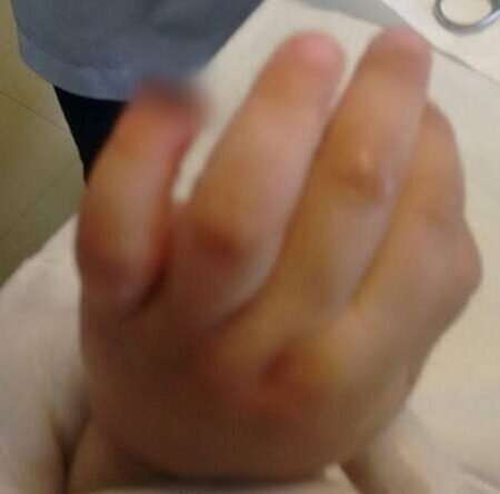 Sobe para R$ 25 mil indenização por criança que teve dedo amputado em Emei