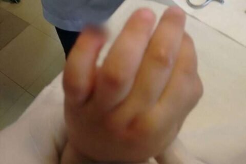 Sobe para R$ 25 mil indenização por criança que teve dedo amputado em Emei