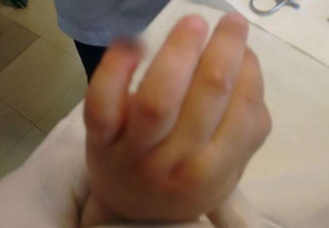 Sobe para R$ 25 mil indenização por criança que teve dedo amputado em Emei