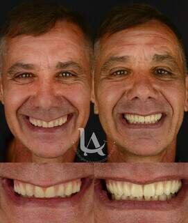 Fim do medo? Implante dentário ganha força em Campo Grande