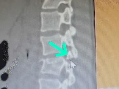 Foi por pouco: exame de sangue salvou Maria de ficar tetraplégica