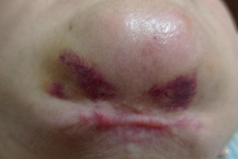 Paciente será indenizada por deformidades no rosto após cirurgias