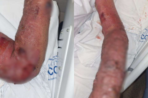 Pedreiro processa município após quase perder braço por erro médico