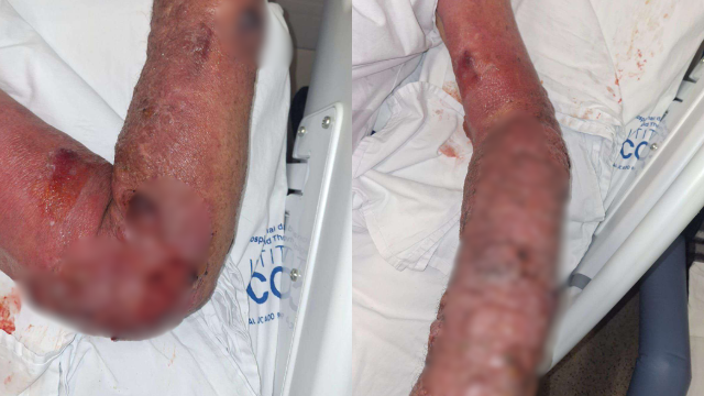 Pedreiro processa município após quase perder braço por erro médico