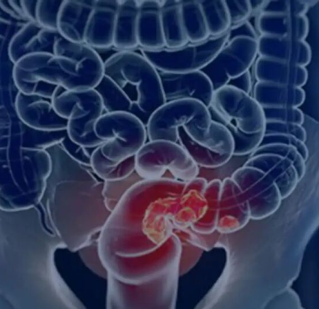 SUS adota teste de fezes para ampliar rastreio de câncer no intestino