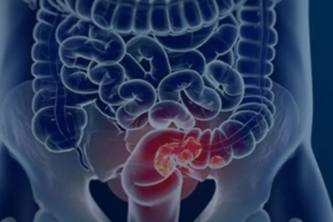 SUS adota teste de fezes para ampliar rastreio de câncer no intestino