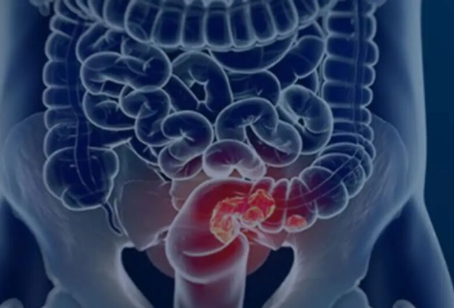 SUS adota teste de fezes para ampliar rastreio de câncer no intestino