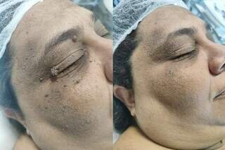 Técnica exclusiva de Jozi Costa remove verrugas sem cicatrizes