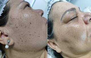 Técnica exclusiva de Jozi Costa remove verrugas sem cicatrizes