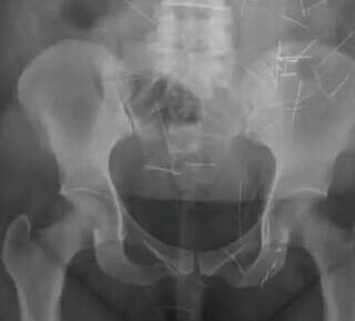 Mulher que fingiu ser criança nunca foi punida em MS e seguiu aplicando golpes