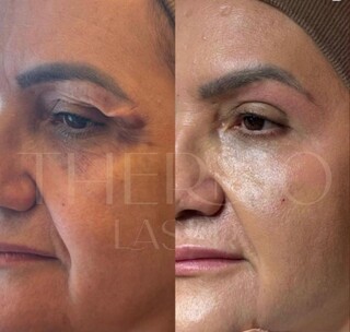 Técnica estimula colágeno e reduz a necessidade de preenchimento