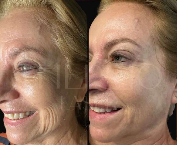 Técnica estimula colágeno e reduz a necessidade de preenchimento