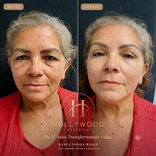 Hollywood celebra 12 anos com Consulta Estética 360° solidária